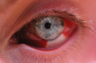 Покраснение глаза после травмы