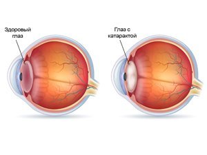 Диагностика и лечение катаракты