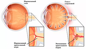 Диагностика и лечение глаукомы